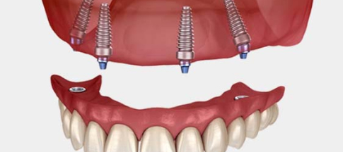 A 2d image showing All on 4 dental implants