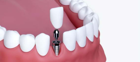 A 2d image showing a single implant and crown