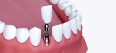 A 2d image showing a single implant and crown