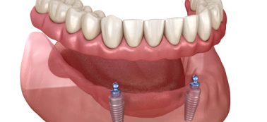 A 2d image showing two implants with a single denture